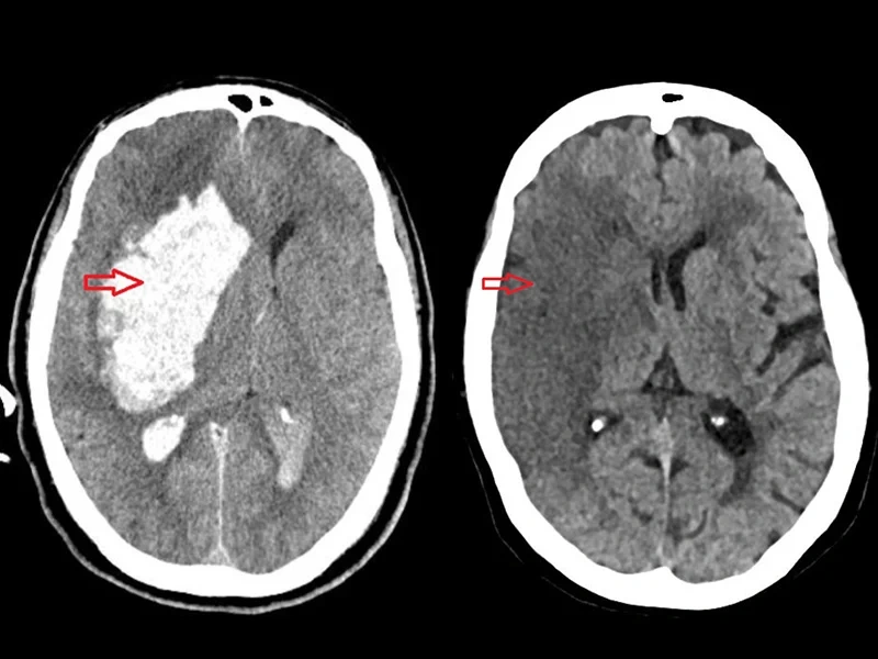 À esquerda, tomografia computadorizada de crânio evidenciando AVC hemorrágico; e à direita, tomografia computadorizada de crânio evidenciando AVC isquêmico