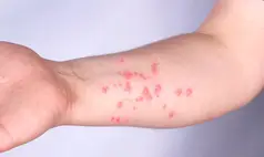 Brasil contabiliza 140 casos confirmados de mpox em 2026