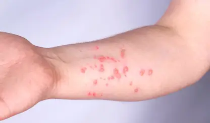 Brasil contabiliza 88 casos confirmados de mpox em 2026